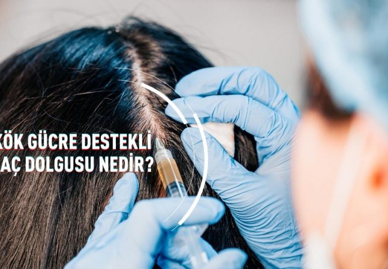 Kök Hücre Destekli Saç Dolgusu nedir