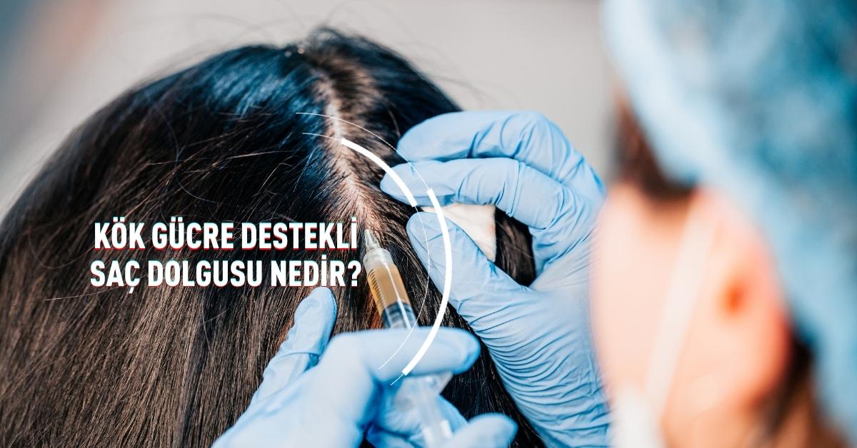 Kök Hücre Destekli Saç Dolgusu nedir
